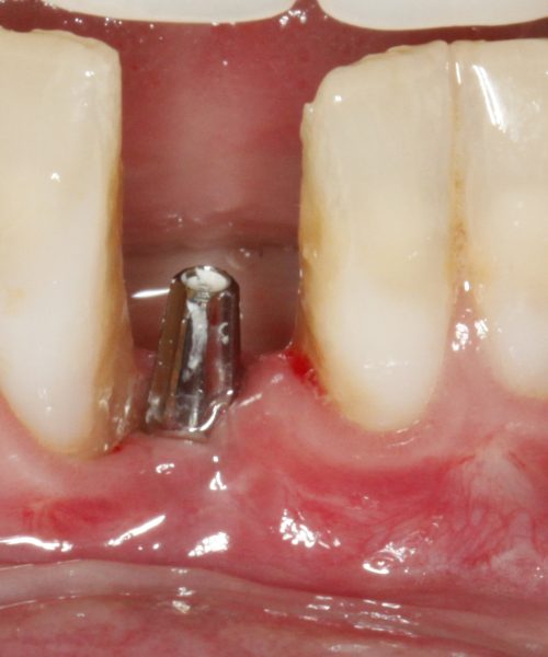 O que o tempo faz com quem perde os dentes